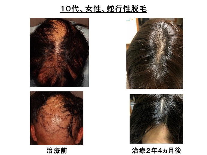 円形脱毛症　病院
